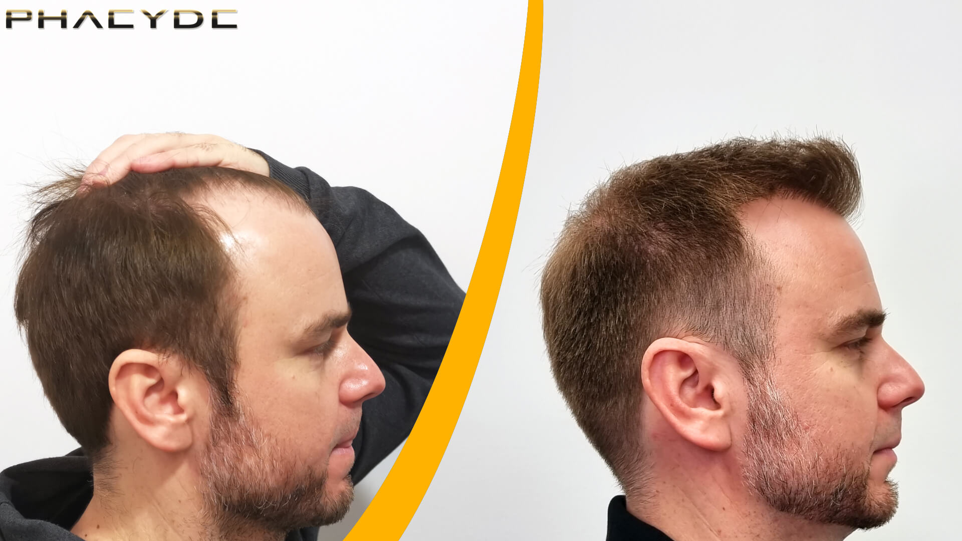 Voor en Na een Haartransplantatie