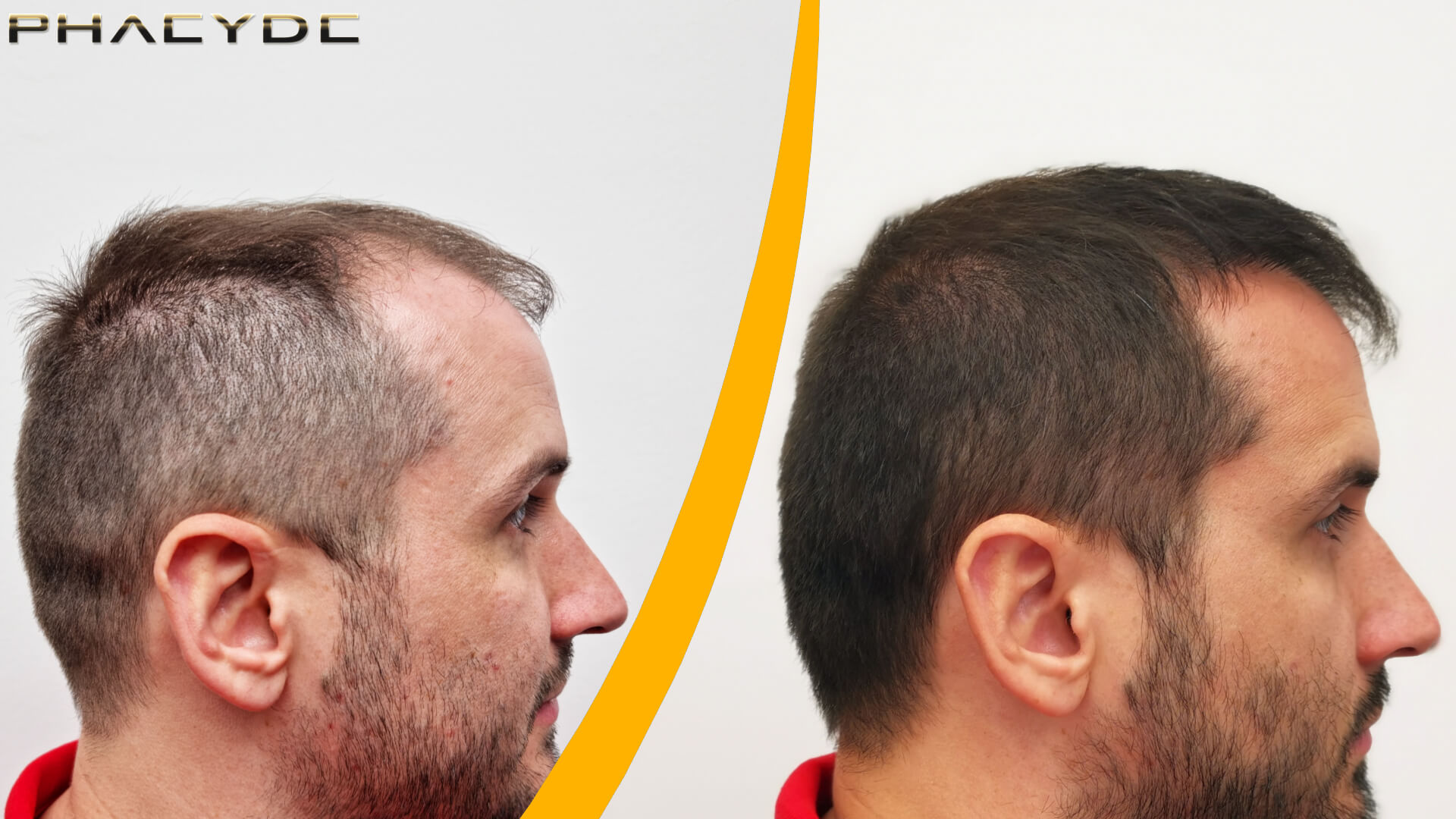 Voor en Na een Haartransplantatie