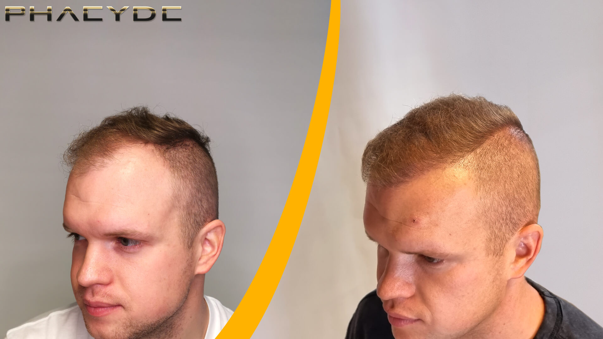 Patrik: Voor en Na de Haartransplantatie