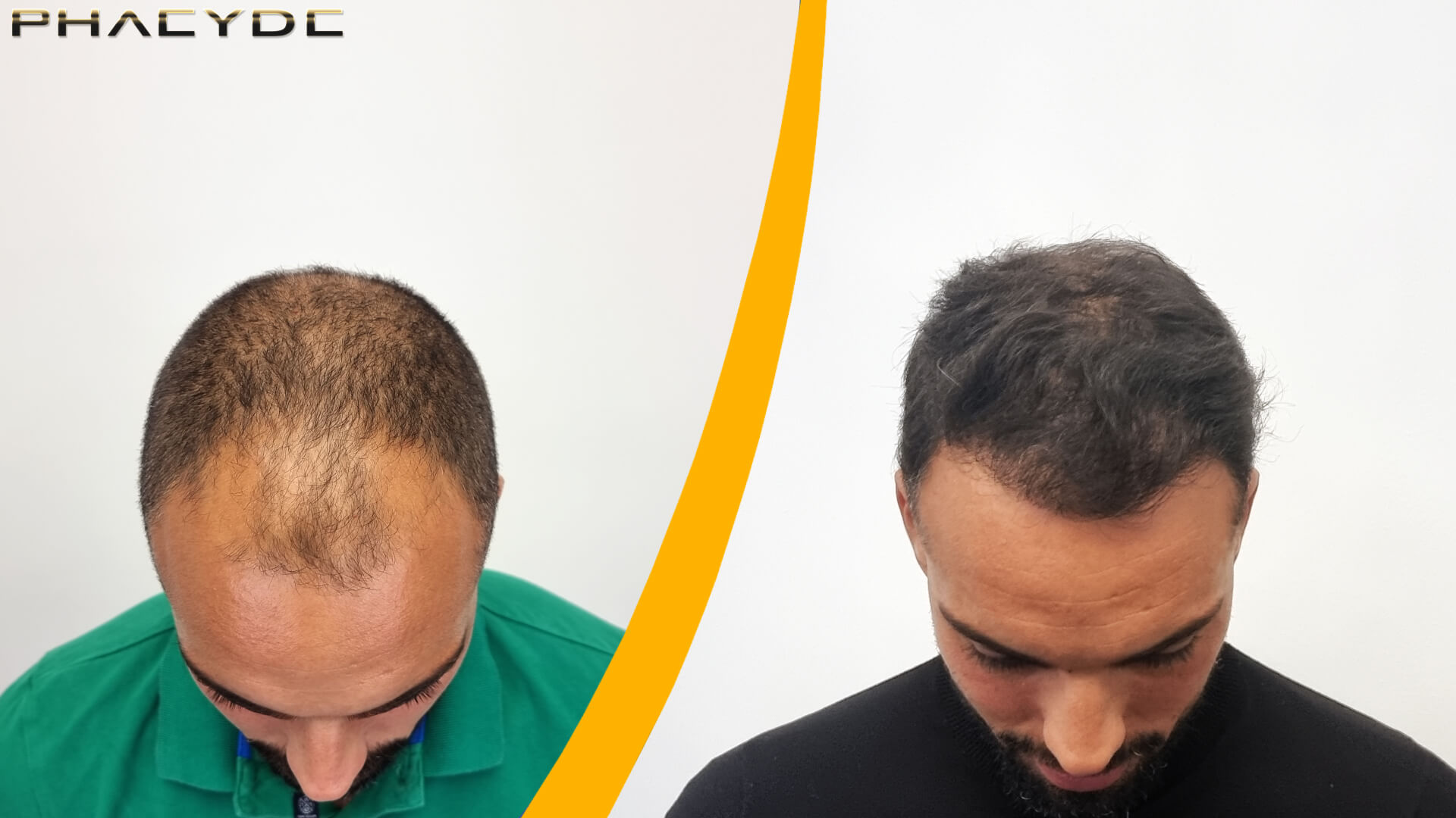 Haartransplantatie Resultaat Voor en Na