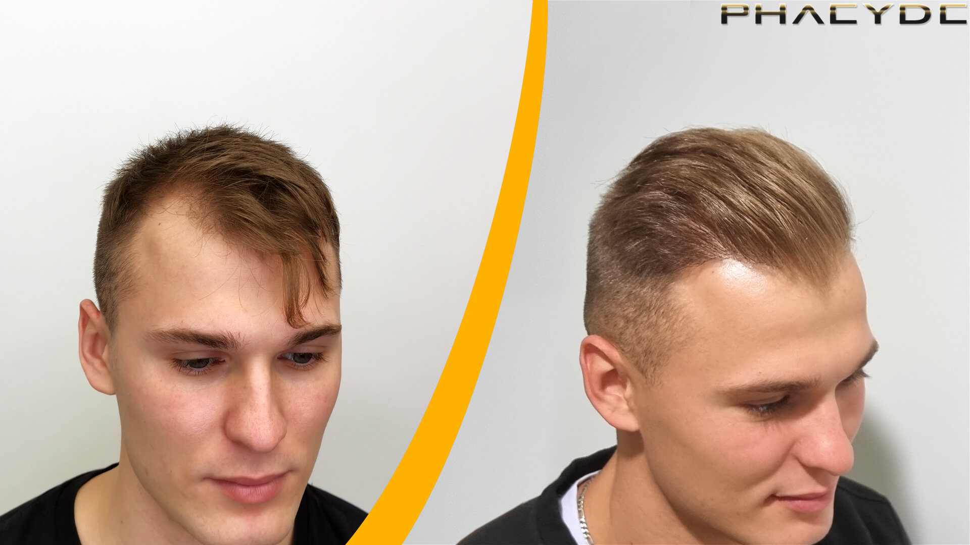Resultaten Voor en Na Haartransplantatie