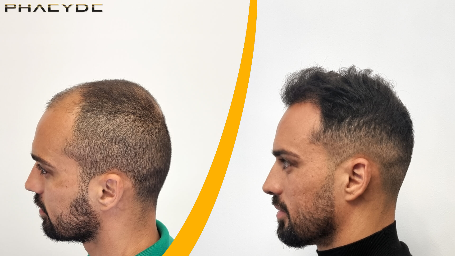 Haartransplantatie - Voor & Na Resultaat