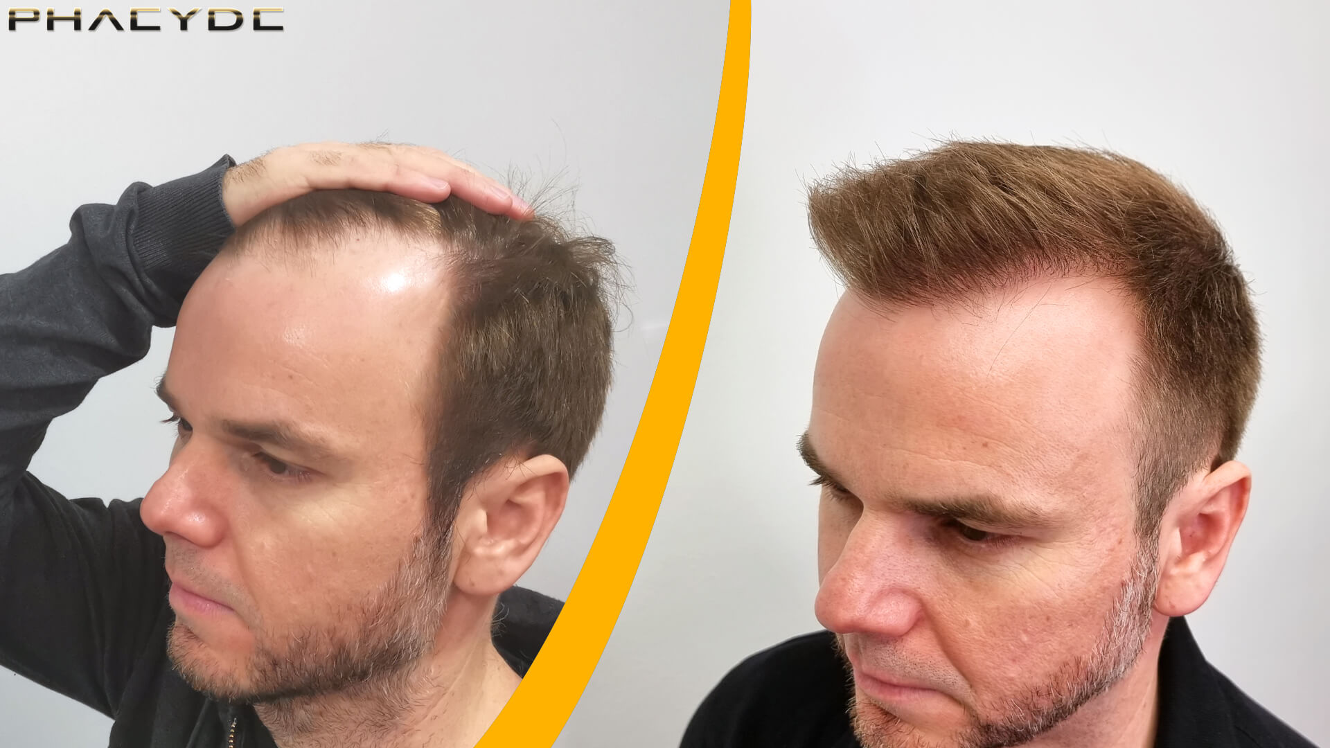 Haartransplantatie - Voor & Na Resultaat