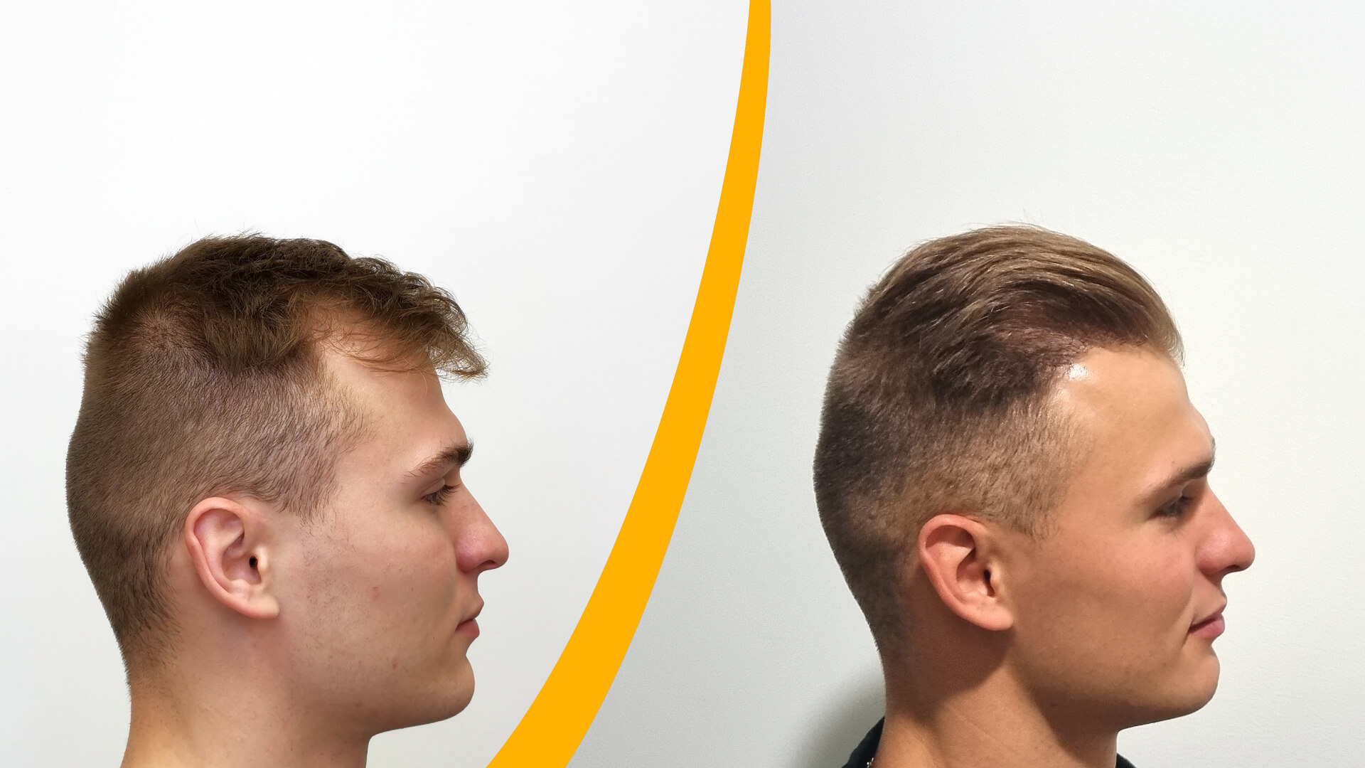 Haartransplantatie - Voor & Na Resultaat