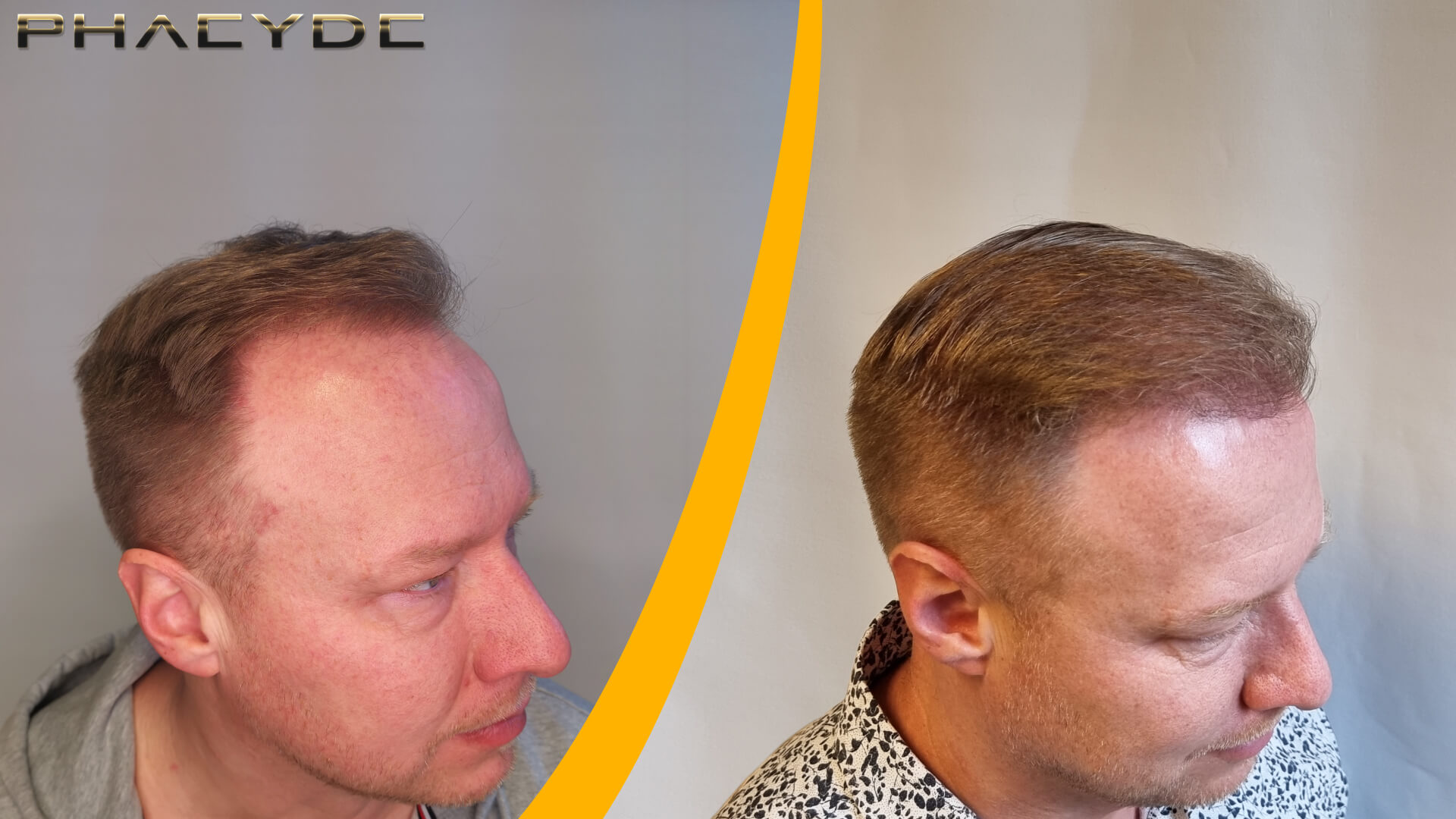 Voor & Na de Haartransplantatie - 1600 Grafts