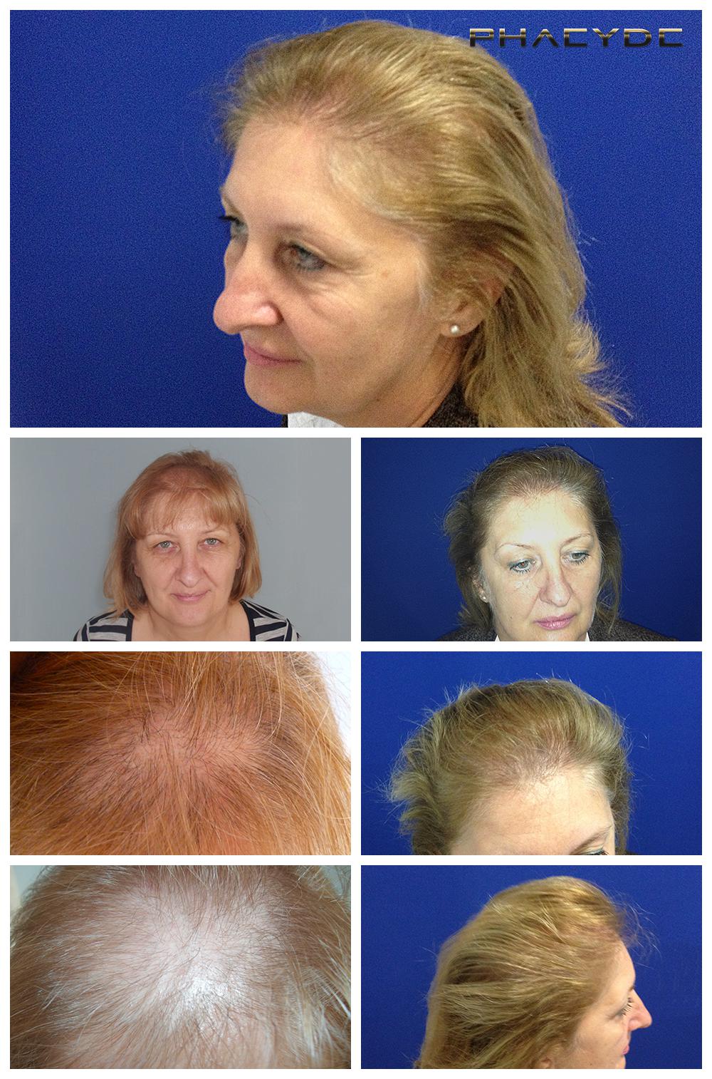 Hair Restoration voor de vrouw